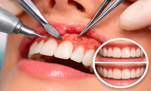 Gum Surgery