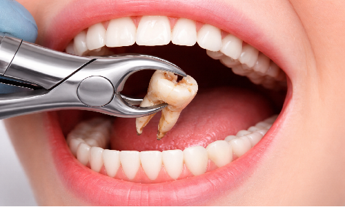 Surgical Extraction