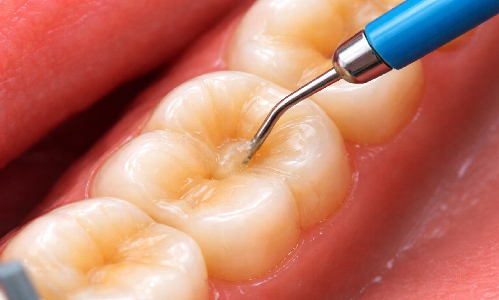 Tooth Colour Filling