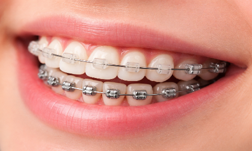 Braces (Metal/Ceramic Brackets)