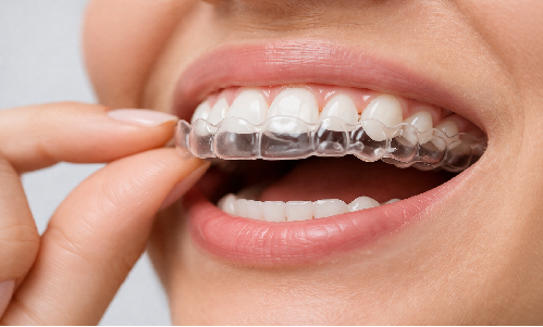 Invisalign / Clear Aligners